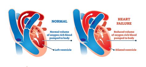 left sided heart failure causes.